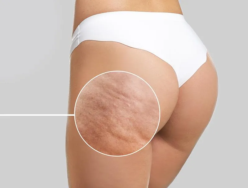 Czy jazda na rowerze może skutecznie zredukować cellulit?