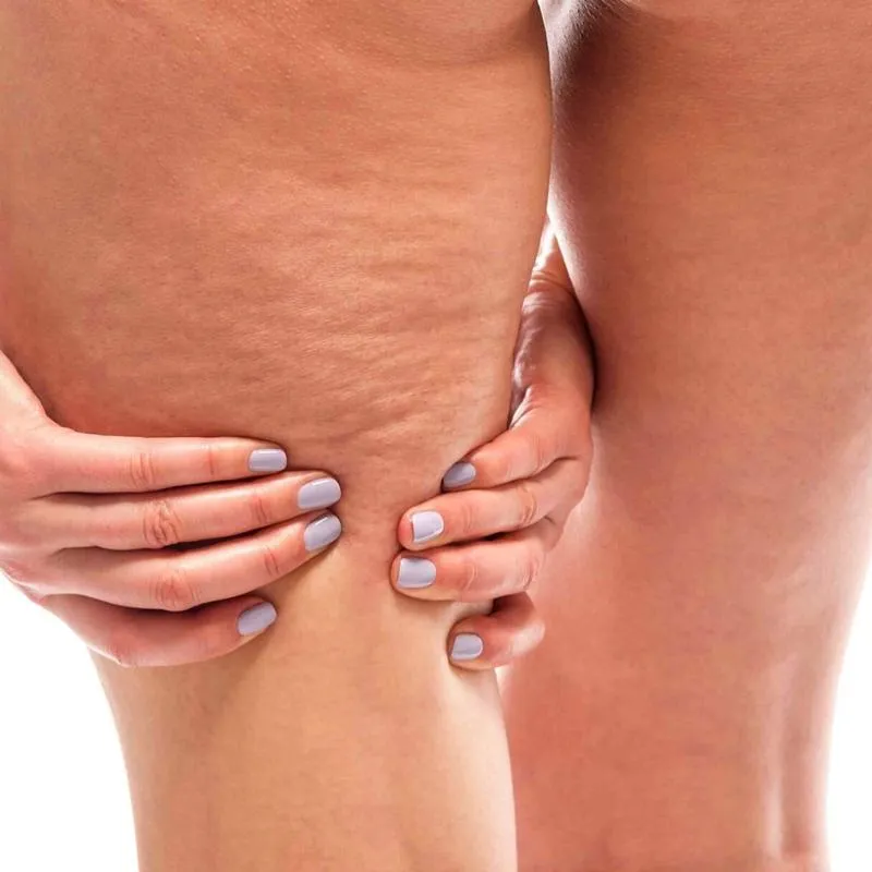 Krążenie krwi i cellulit